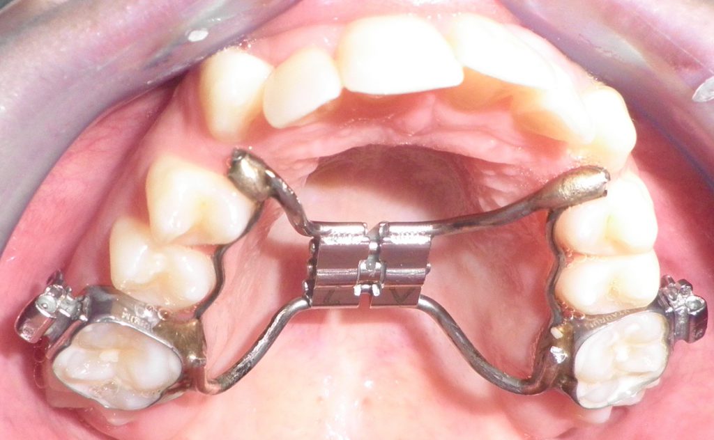 Οδοντοστοιχία με σταθερό μηχανισμό διεύρυνσης γνάθου