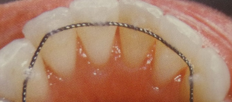 Οδοντοστοιχία με σταθερά συγκρατητικά